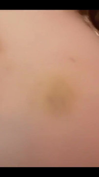 Bruise on Tits Update