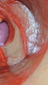Ženské Inseminace - Vnitřní Kamera Zachycuje Hlubokou Mužskou Obrovskou Ejakulaci