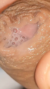 Curioso Close up De Pré Cum Na Fimose Flácida.