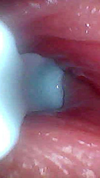 Ik Kon Niet Geloven Wat Er in De Penis Gebeurt Als Het Sperma Erdoorheen Gaat (endoscopische Beelden)