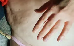 22 Anni scarlatto cesareo