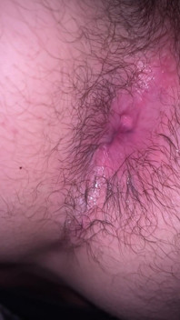 Bruised Asshole
