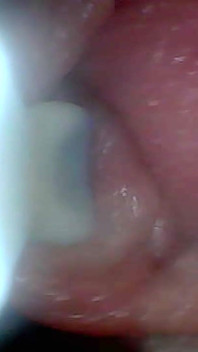 Endoscope Camera Shows the Most Sensitive Parts of the Penis Educational Video