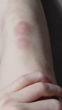 I Show You the Bruises on My Legs After Rough Sex