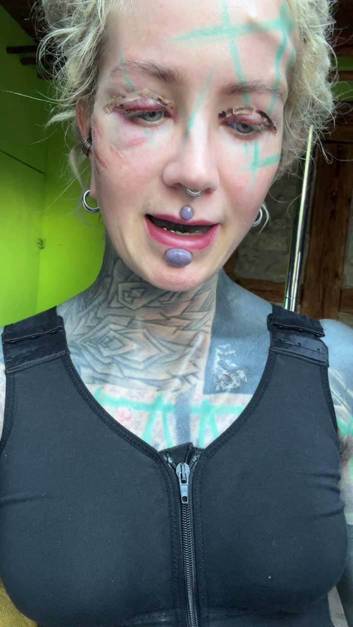 Anuskatzz: Day 3 After My Boobs and Upper Blephoplasty Op