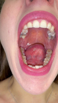 Mouth Secrets: Thick White Coating on My Tongue