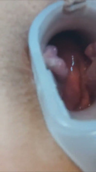 Anal Examination