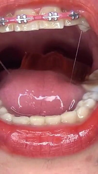 Swallowing Large Gummy Bears, Putting Them in the Vagina