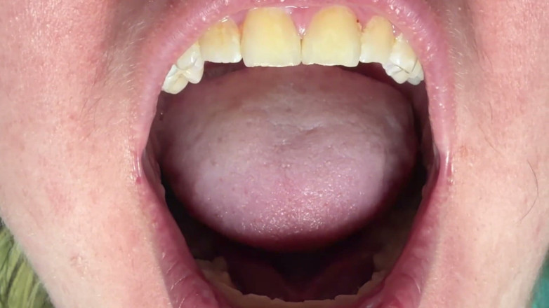 Spunk Kip: Mouth &amp; Tonsils Close-up