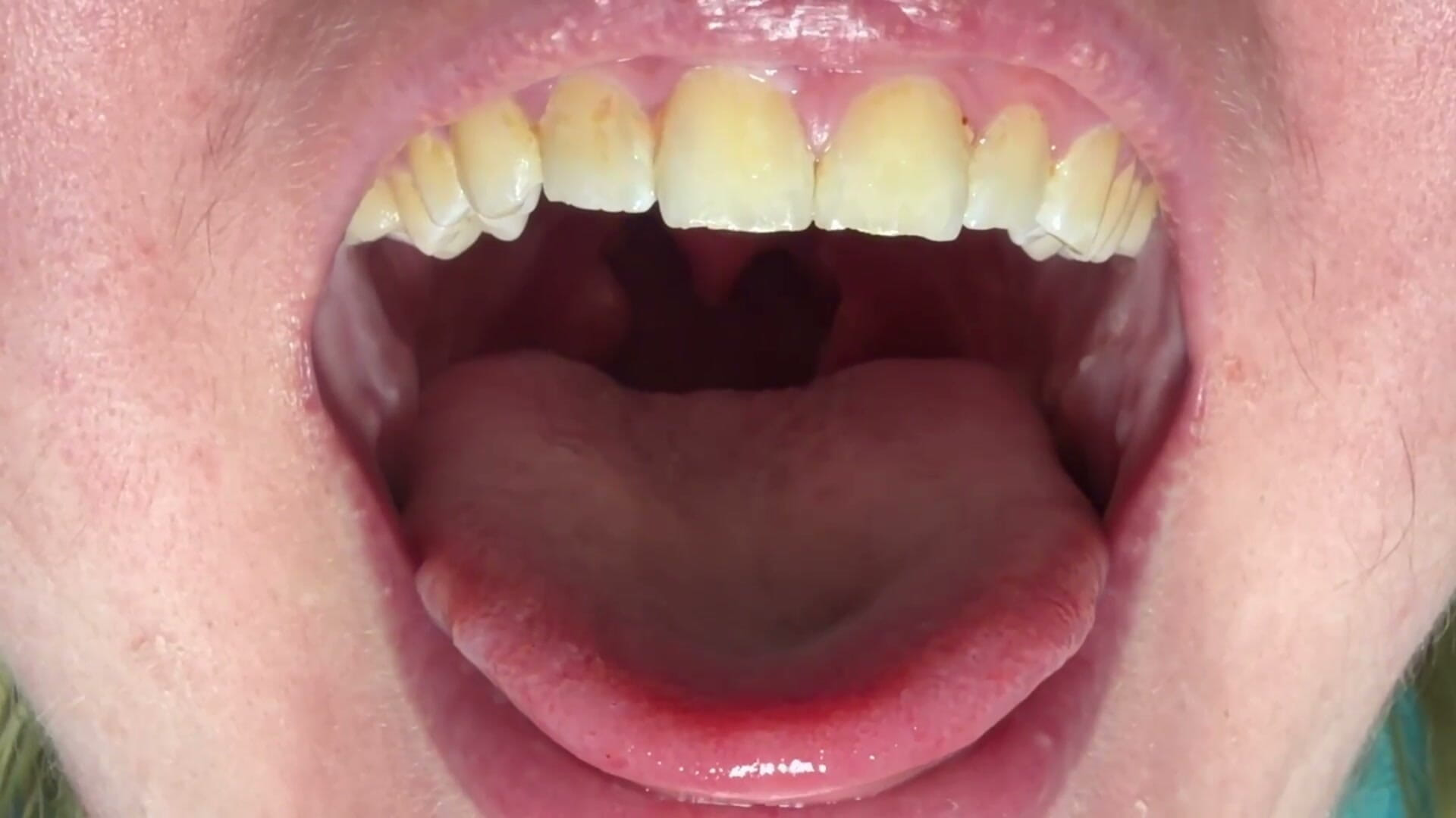 Mouth & Tonsils Close-up