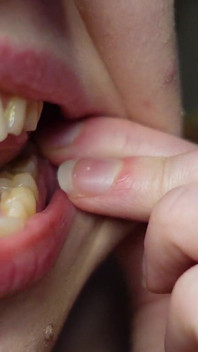 Je Te Parle Des Obturations Dans Mes Dents Et Des Visites Chez Les Dentistes