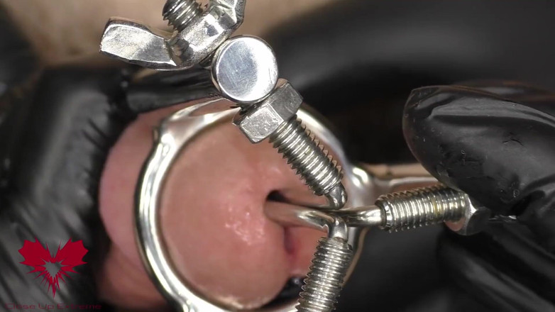 Close Up Extreme: Primo piano dell'applicazione di un barella uretrale a 3 vie. il...
