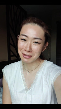 วันที่ 3 หลังผ่าตัด