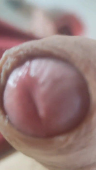 Membuka parut frenulum kasar!