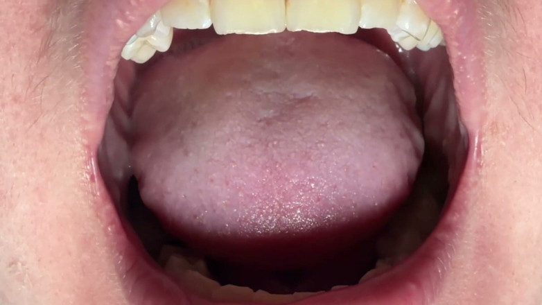 Spunk Kip: Mouth &amp; Tonsils Close-up