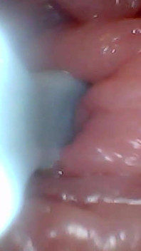Prima volta: un endoscopio rivela il punto G in primo piano - senza l'analisi!