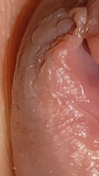 The World's Largest Foreskin Opening and Closing.
