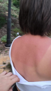 She Really Likes to Sunburn