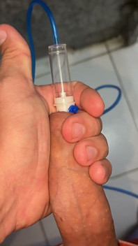 Sonorizzazione: Sondaggi Estremamente Netti Nel Canale Uretrale.