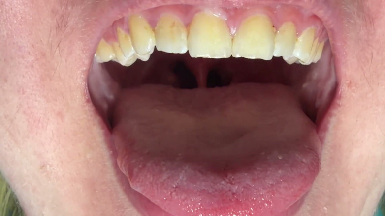 Spunk Kip: Mouth &amp; Tonsils Close-up