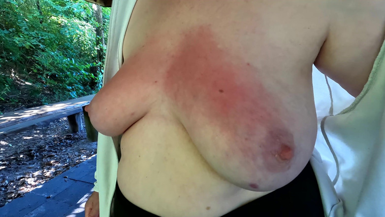 Bouncy Tits Action: Red and Swollen Tits at Public Bbq Place