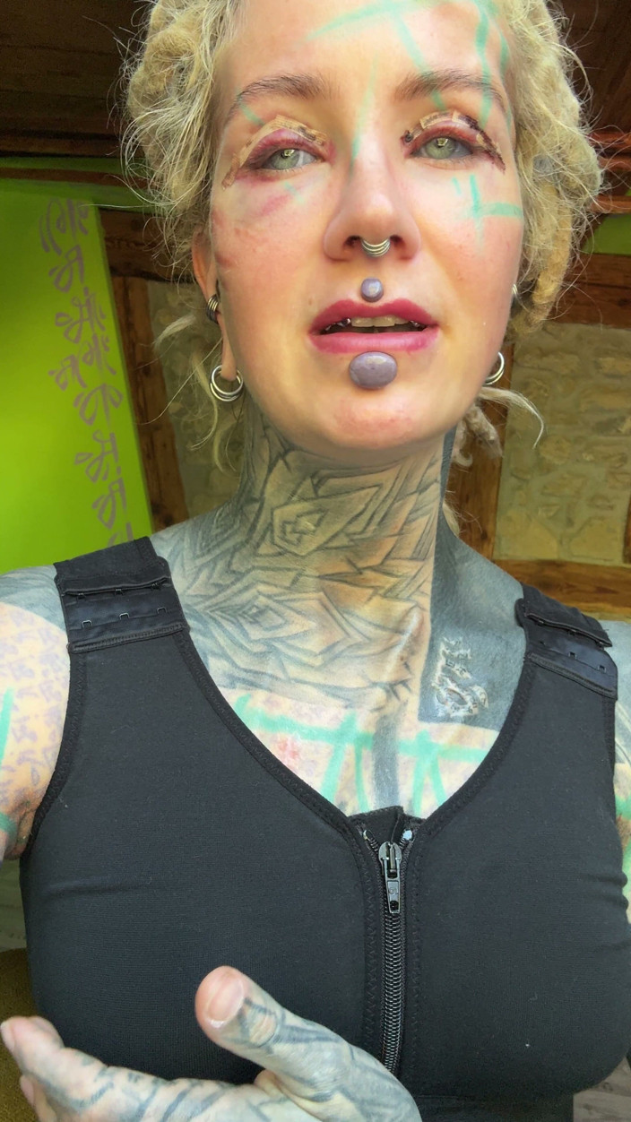 Anuskatzz: Day 3 After My Boobs and Upper Blephoplasty Op