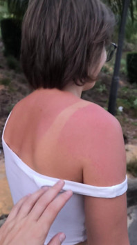 She Really Likes to Sunburn