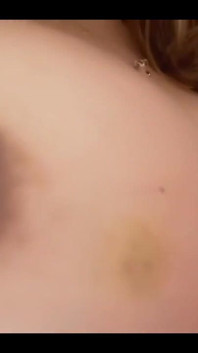 Bruise on Tits Update