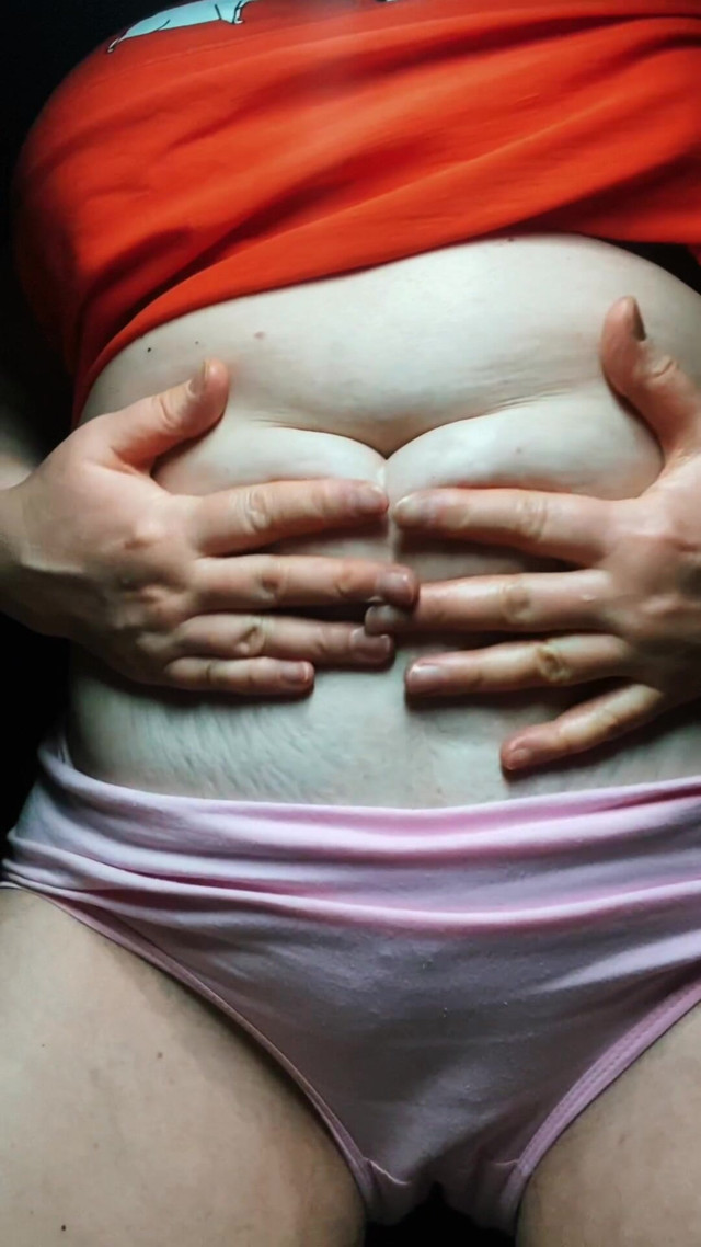 22 Year Caesarean Scar (Vikki Georgia) 22 Year Caesarean Scar (Vikki Georgia)