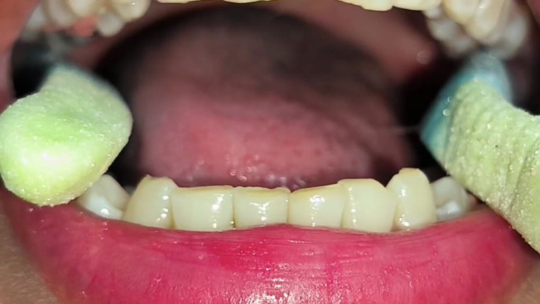 Isabel: Snake Gum