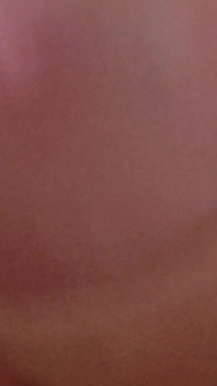 Immense Phimosis Being Extracted Cum and Précum.