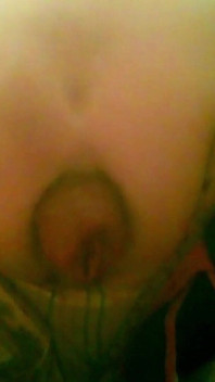 A Young Guy Is Sitting on a Chair with Anal Prolapse