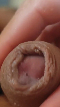 Große Phimose, Die Dem Orgasmus Des Jungen Im Weg Steht.