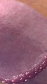 Tayson's glands or pearly papules
