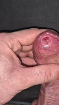 A Closer Look at My Naturally Tight Phimosis