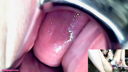 AdalynnX: Adalynnx - Endoscope, spéculum hitachi, vib
