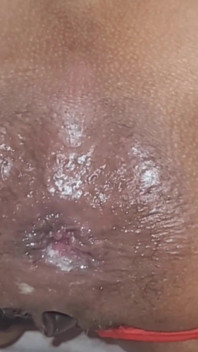 Trying to Get the Sperm Out, It Was so Deep That It Didn't Come Out