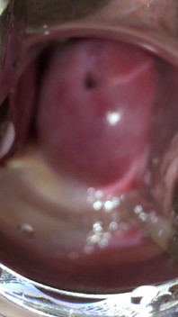 Inseminacja szyjki macicy