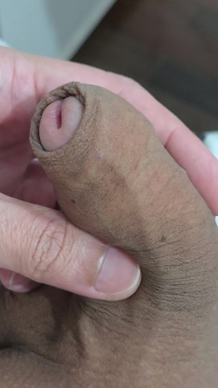 Lkdick8: ¿Qué son estas manchas en mi pene?