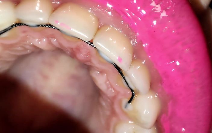 Princess18_: Permanente retainers mondtour