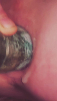 Dilatation Anal