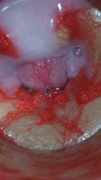 Camera Inside Deep Pussy Captures Very Huge Ejaculation of Sperm Asmr