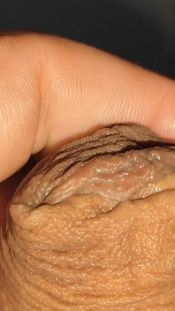 Big Uncircumcised Dick Opening Phimosis of the Glans.
