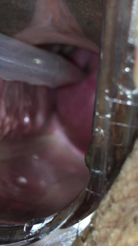 Inseminación en el cuello uterino