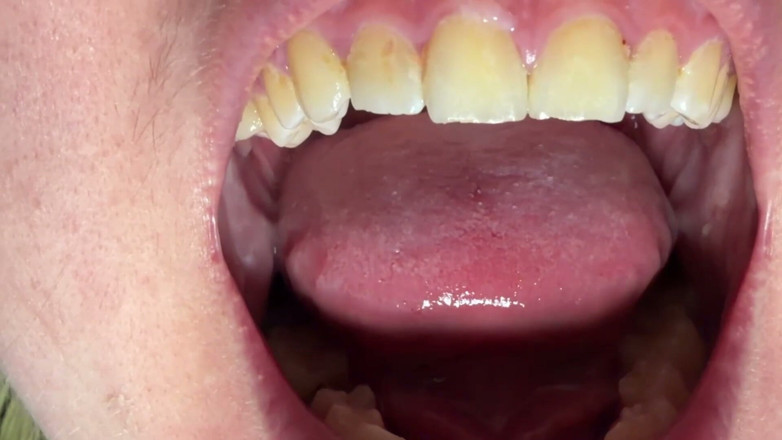 Spunk Kip: Mouth &amp; Tonsils Close-up