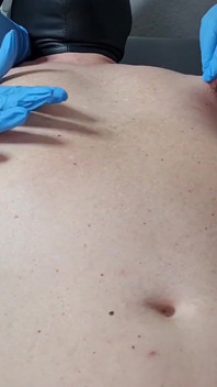 Hanna Engelss - Estimulación del pezón mediante la aguja