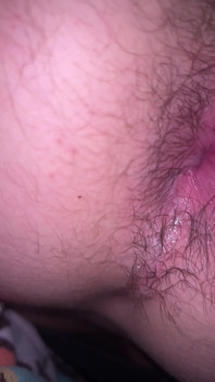 Bruised Asshole