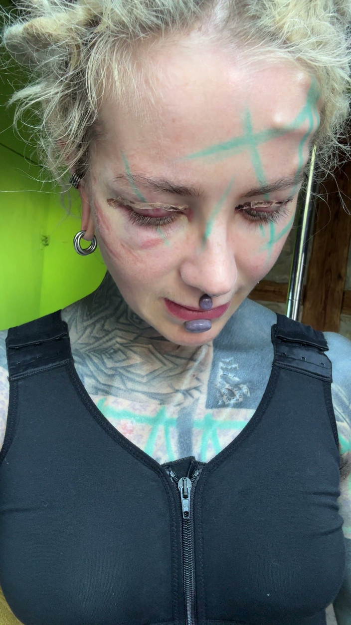 Anuskatzz: Day 3 After My Boobs and Upper Blephoplasty Op