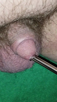 Sondage urétral de 7 à 8 mm avec éjaculation