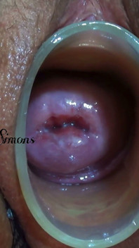 This Is What My Cervix Looks Like After a Year Without Seeing It.